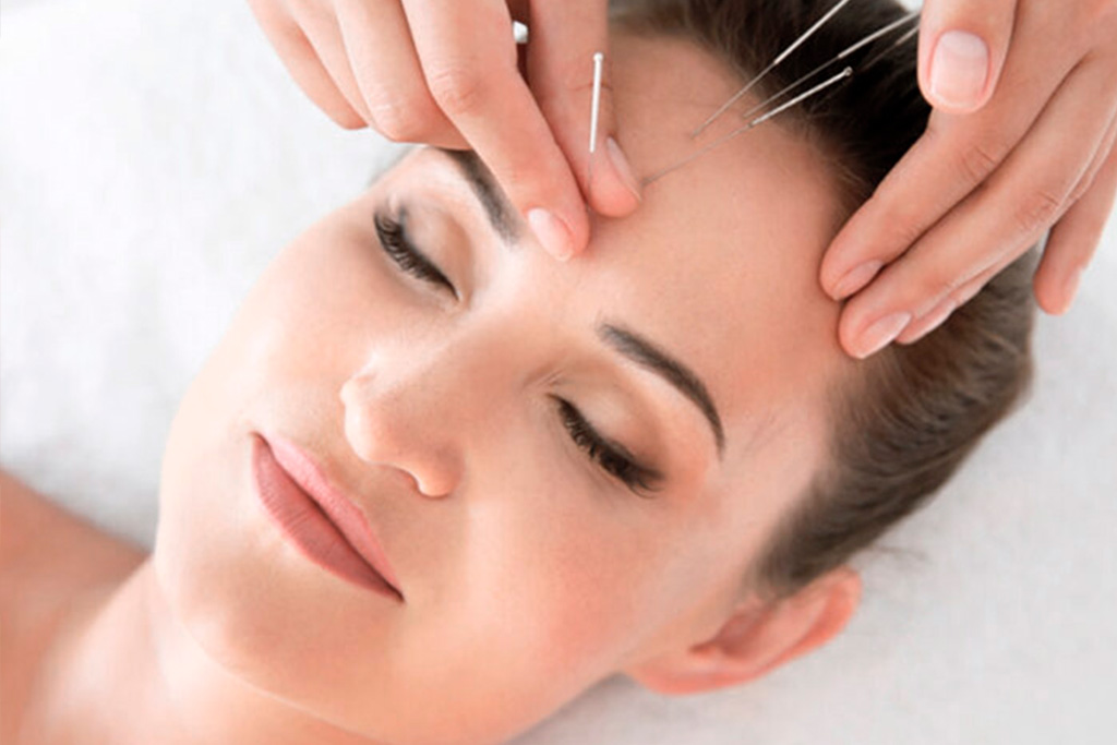 acupuntura_facial